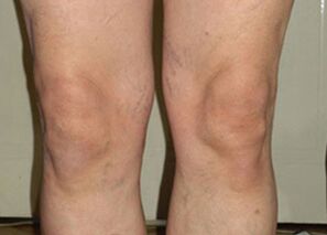 Após um curso de uso de Osteflex, as articulações voltaram ao normal